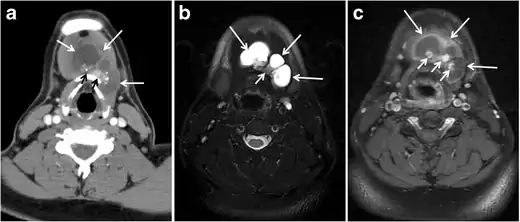 Fig. 21. Papillary thyroid carcinoma arising from a thyroglossal duct cyst in a 28-year-old male. an Axial enhanced CT scan shows a large complex cystic lesion (white arrows) adherent to the anterior aspect of the hyoid bone. It has an enhancing mural solid nodules and calcifications (black arrows). There is no cervical lymphadenopathy. b Axial short tau inversion recovery (STIR) MRI image near the same level shows complex lesion of high signal intensity (long white arrows) with solid mural nodules (short white arrow). c Axial fat saturated T1 MRI image post contrast administration shows the complex cystic lesion with thick enhancing wall (long white arrows) and enhancing mural nodules (short white arrows).