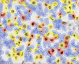 Ki67 stain calculation by QuPath in a pure seminoma, which gives a measure of the proliferation rate of the tumor. The colors represent the intensity of expression: blue-no expression, yellow-low, orange-moderate, and red-high expression.